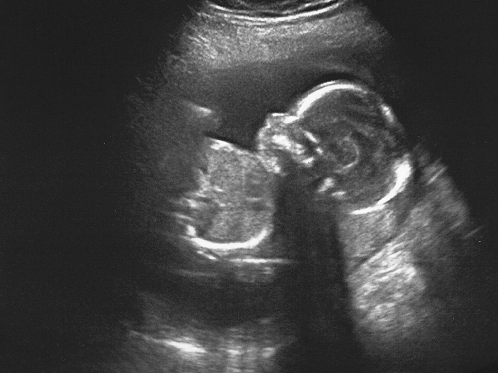 ultrasound image of baby